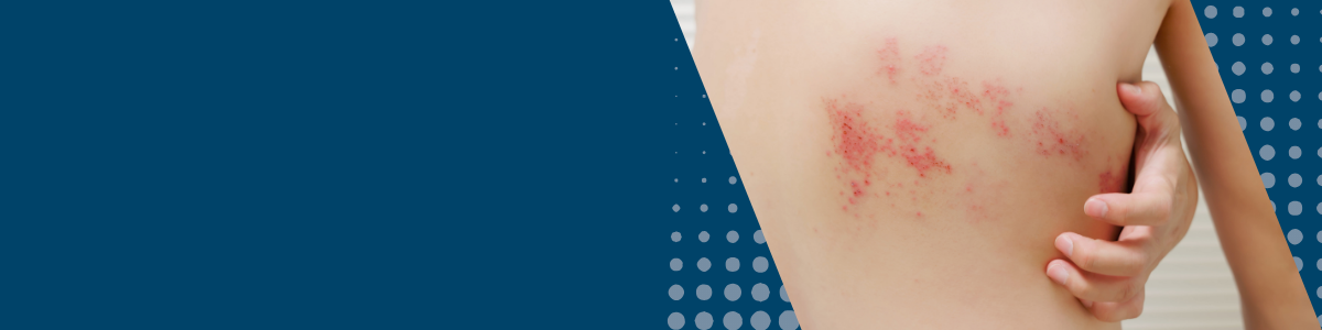 Zbliżenie na skórę z wysypką charakterystyczną dla półpaśca